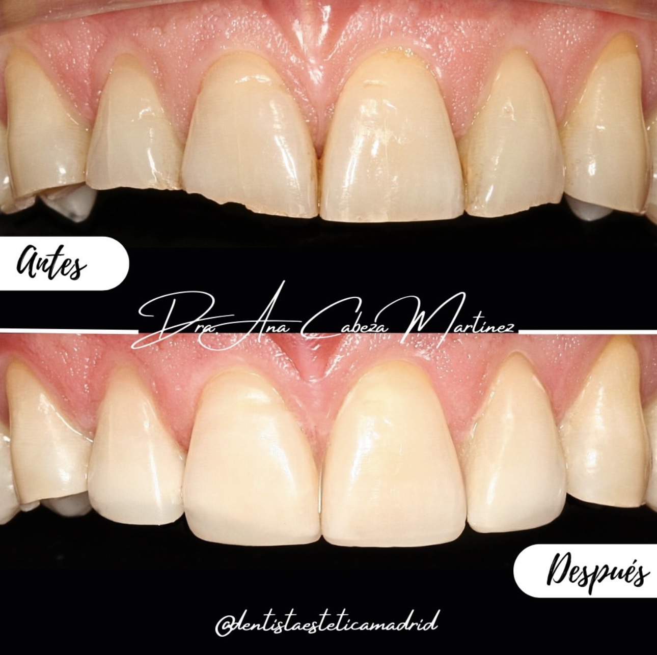 Antes y después de carillas palatinas de composite en dientes desgastados, caso de la Dra. Ana Cabeza Martínez